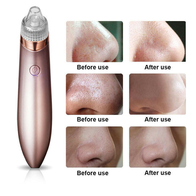 Electric Blackhead Remover Vacuum – Pore Cleaner & Acne Extractor with Suction