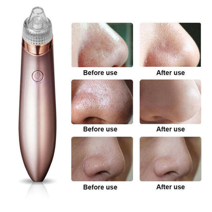 Electric Blackhead Remover Vacuum – Pore Cleaner & Acne Extractor with Suction